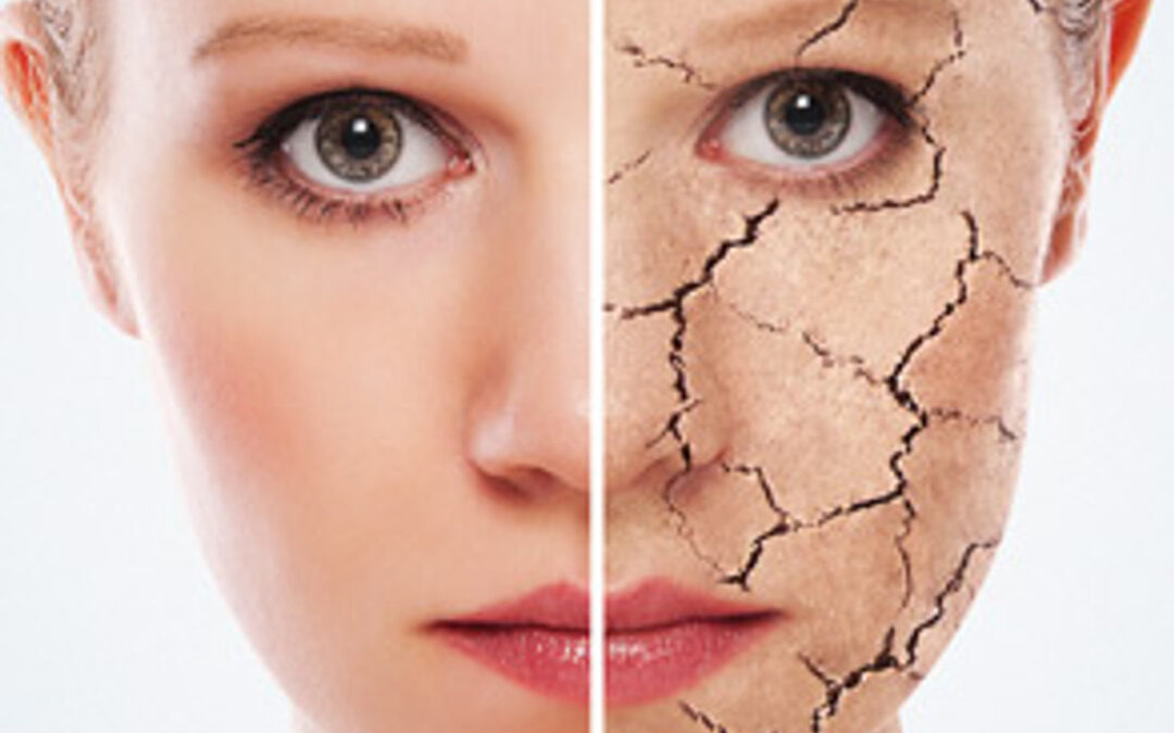 Tips to protect dry skin from the climate.